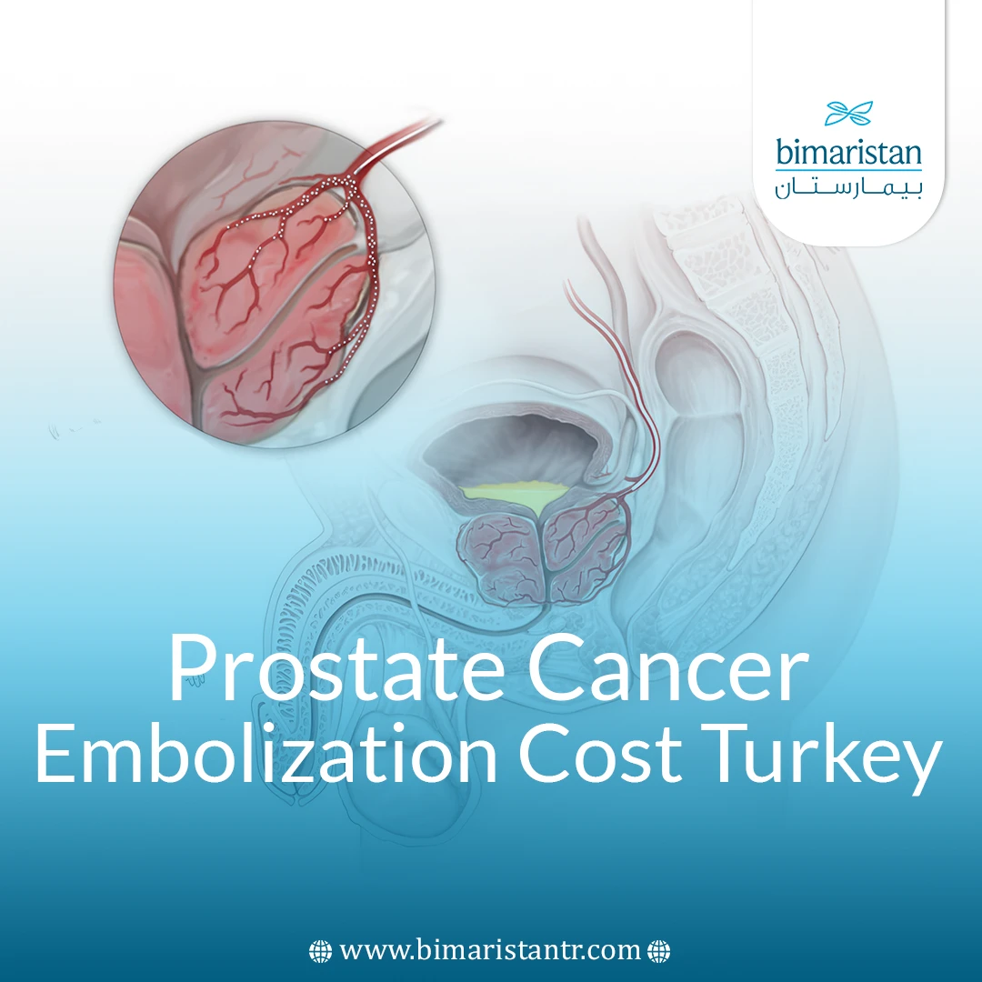 Prostate Cancer Embolization Cost In Turkey: The Complete 2025 Guide