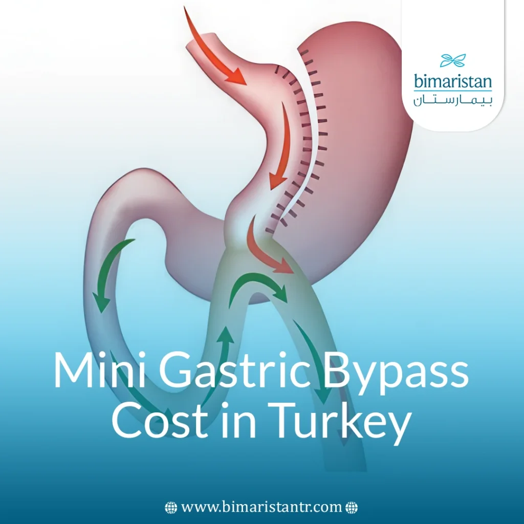 Mini Gastric Bypass Cost In Turkey
