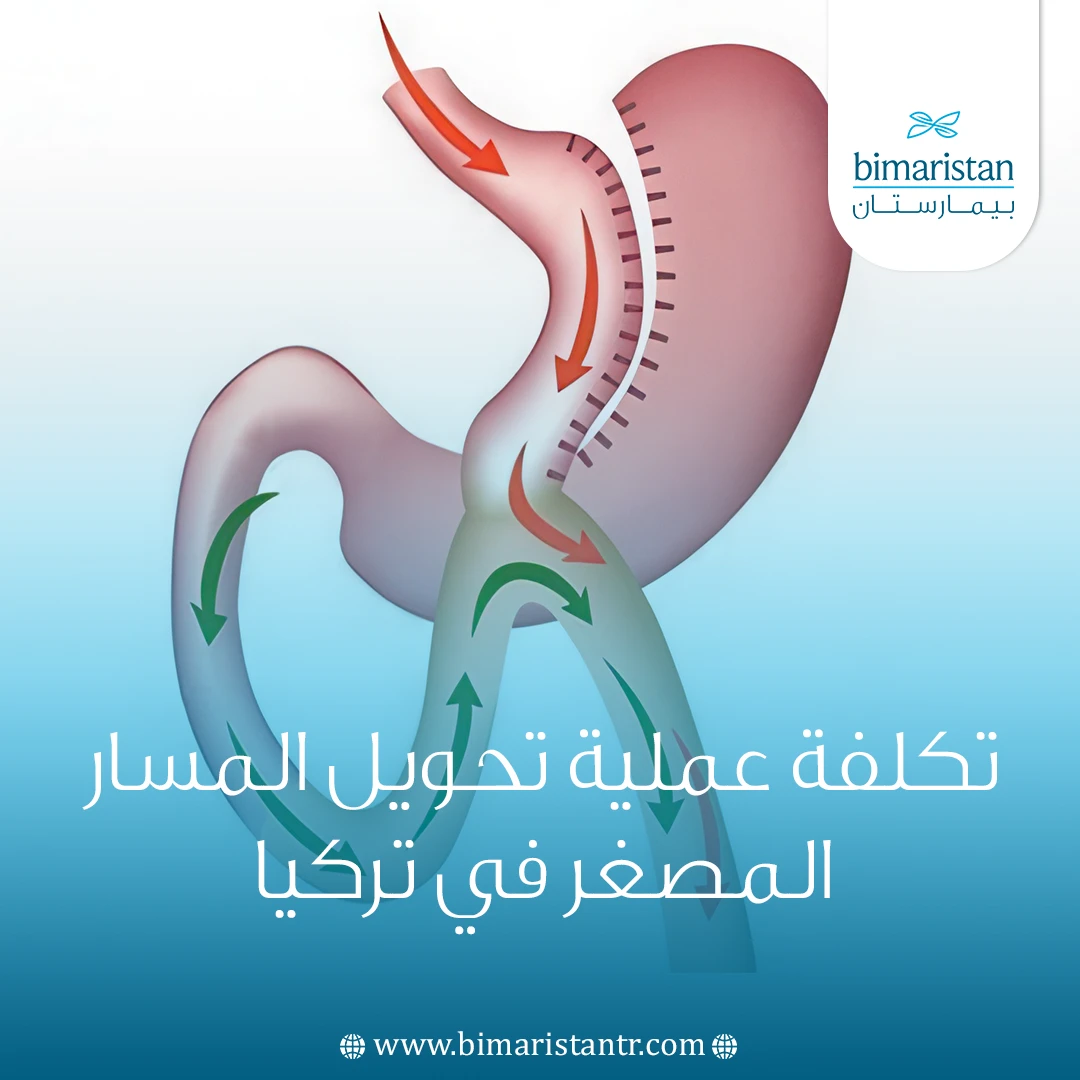 تكلفة عملية تحويل المسار المصغر في تركيا