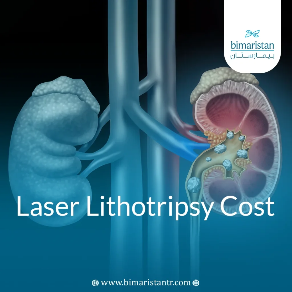 Laser Lithotripsy Cost In Turkey: Comprehensive Guide