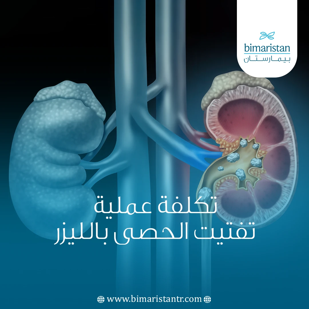 تكلفة عملية تفتيت الحصى بالليزر في تركيا: الدليل الشامل