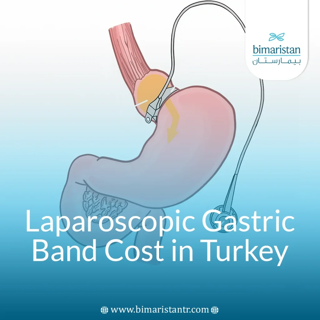 Laparoscopic Gastric Banding Cost In Turkey