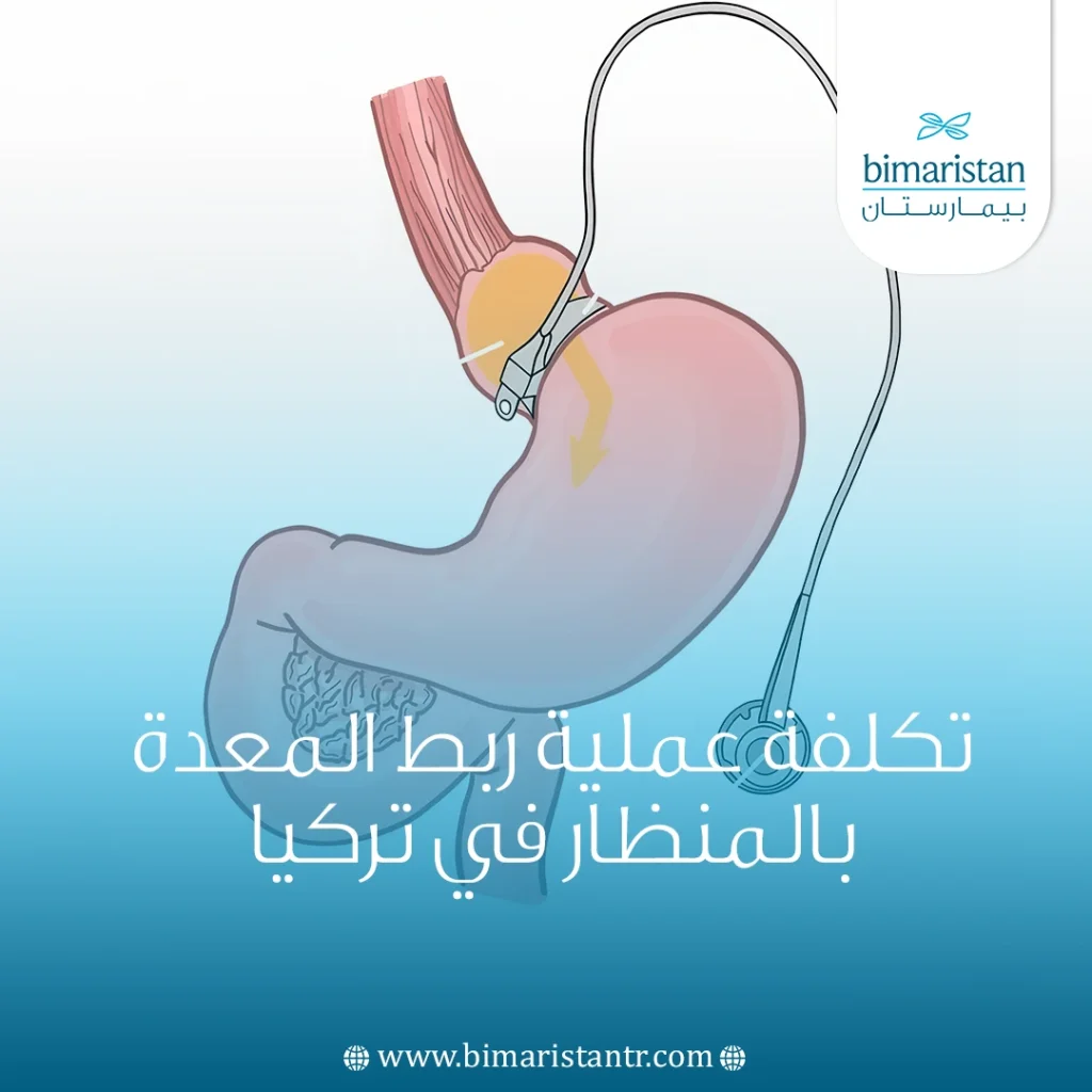 تكلفة عملية ربط المعدة بالمنظار في تركيا