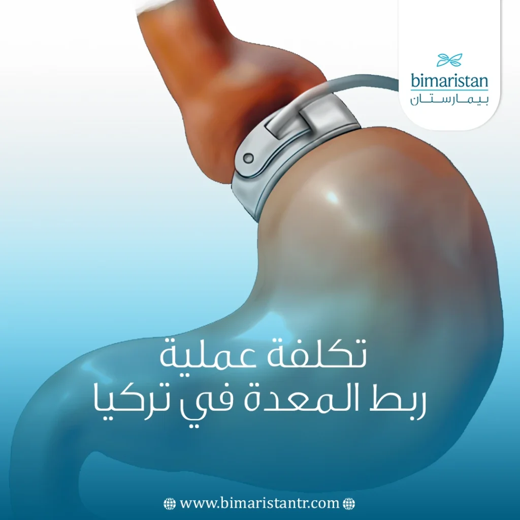 تكلفة عملية ربط المعدة في تركيا