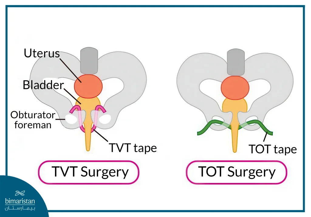 urinary-incontinence-surgery-cost-in-turkey-quality-price