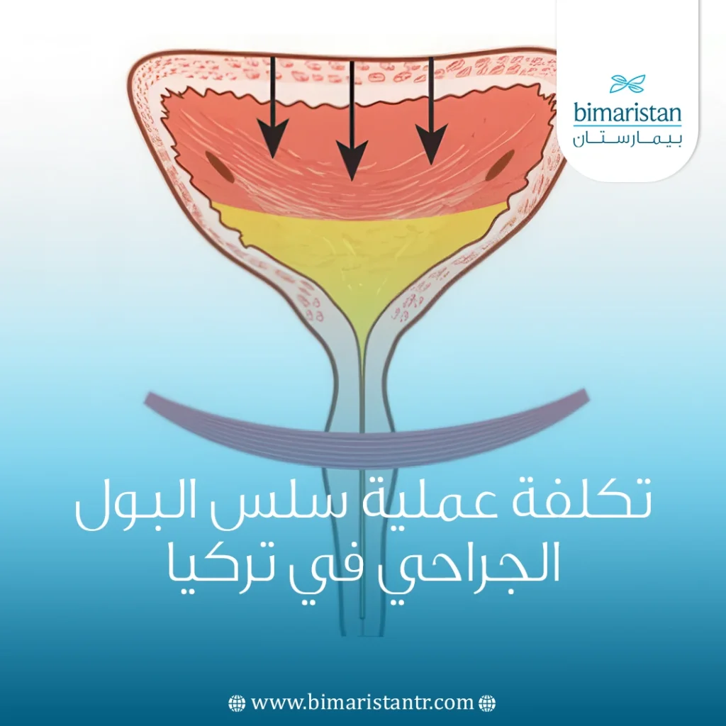 تكلفة عملية سلس البول الجراحي في تركيا