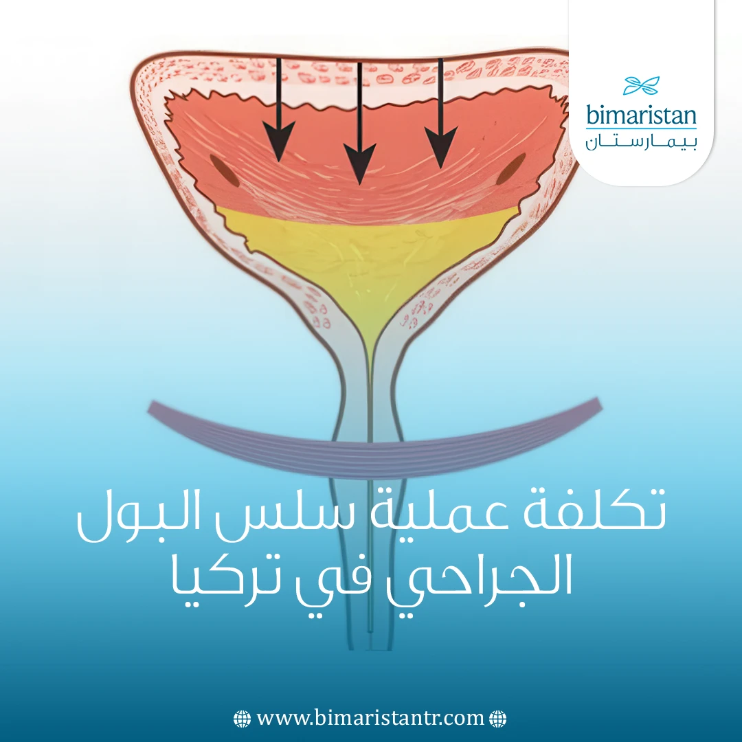 تكلفة عملية سلس البول الجراحي في تركيا 2025: جودة وأسعار مفاجئة