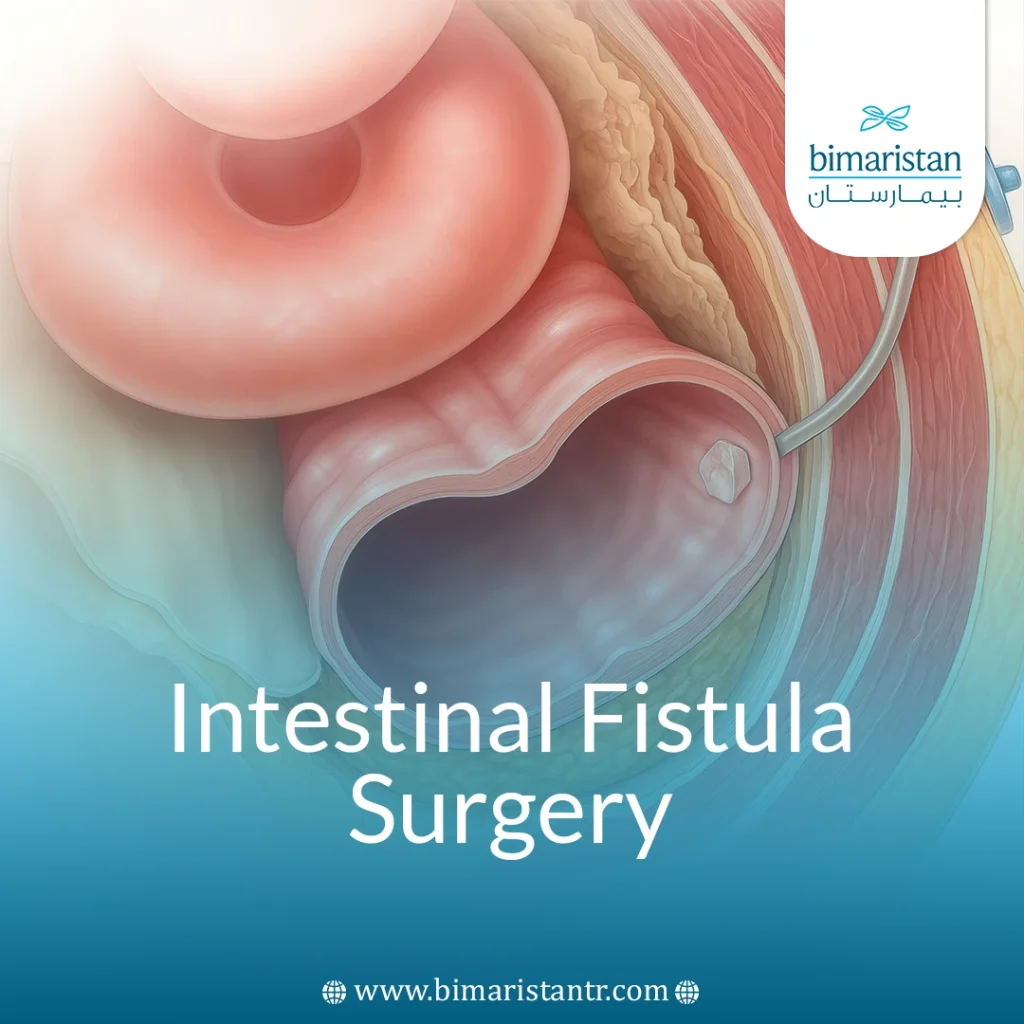 Intestinal Fistula Surgery: Indications And How It'S Done