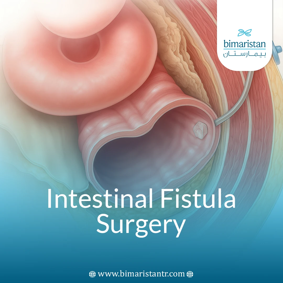 Intestinal Fistula Surgery: Indications, Procedure Steps, And Recovery Explained