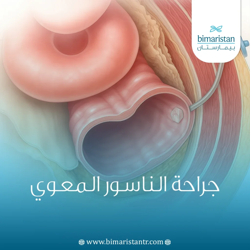 جراحة الناسور المعوي