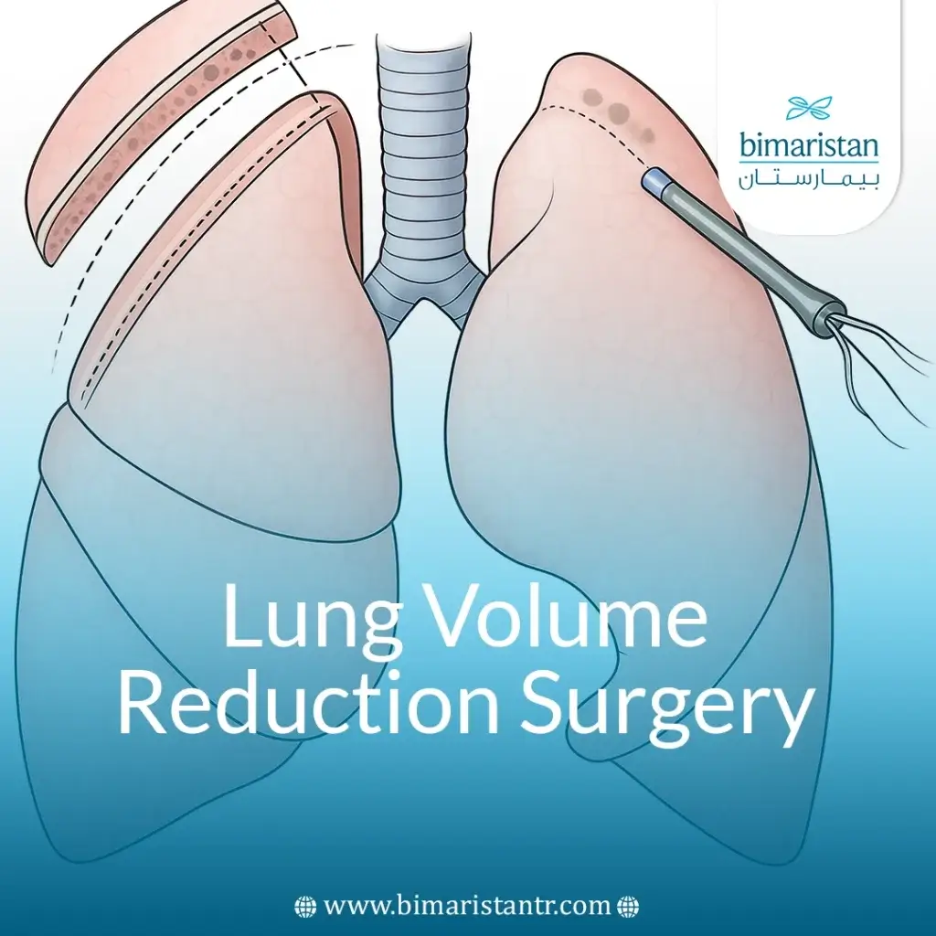 Lung Volume Reduction Surgery: Improve Breathing &Amp; Life