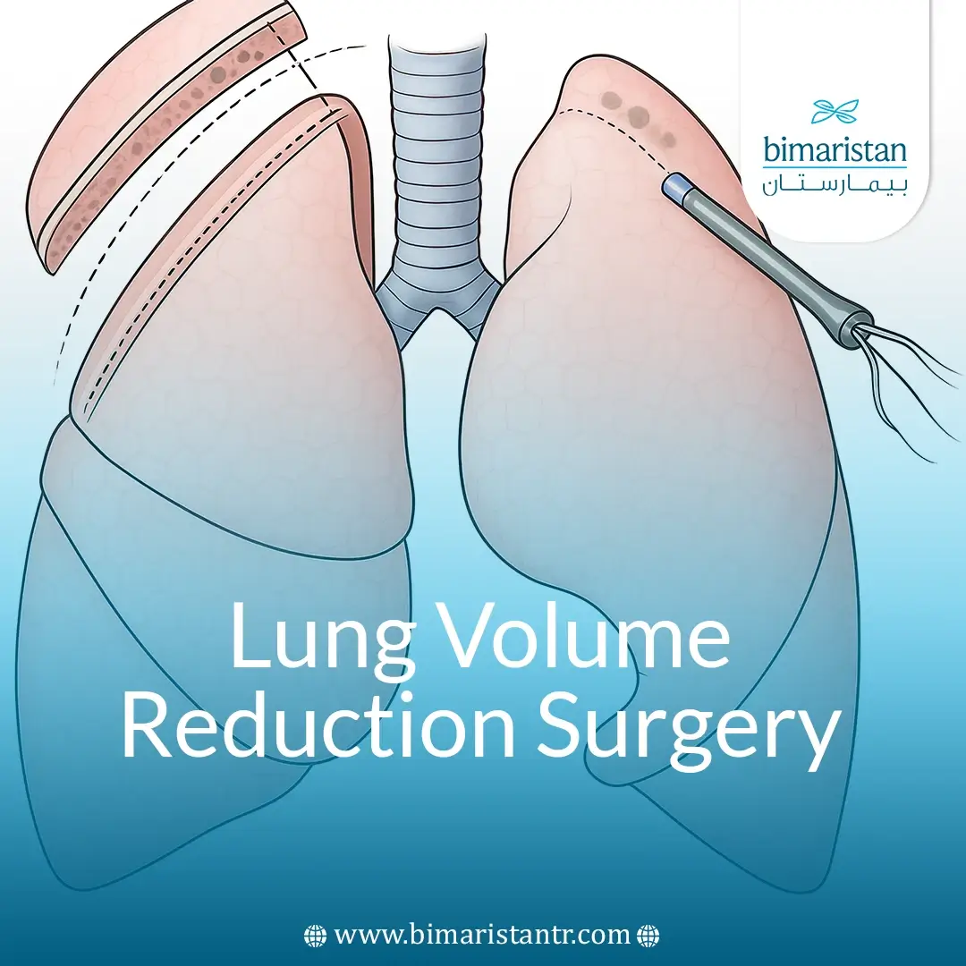 Lung Volume Reduction Surgery: Improve Breathing &Amp;Amp; Life