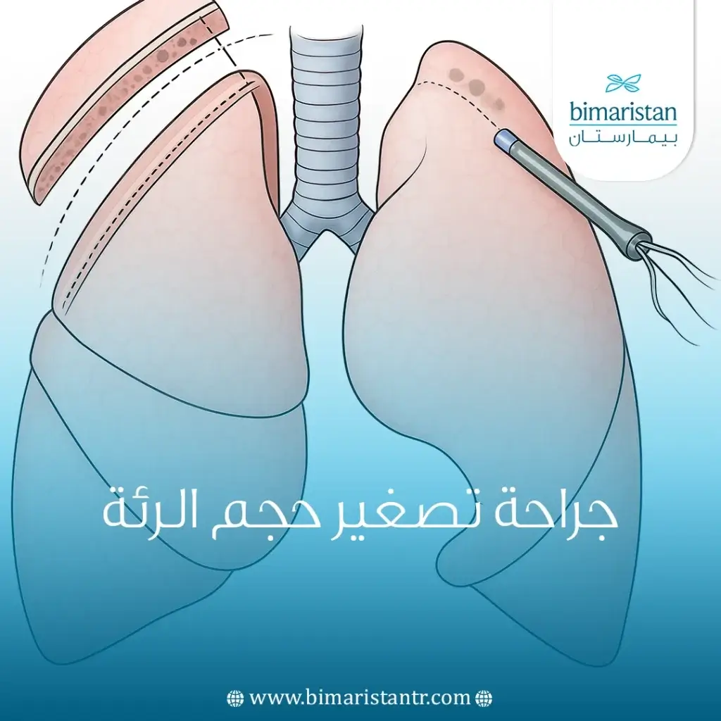 جراحة تصغير حجم الرئة