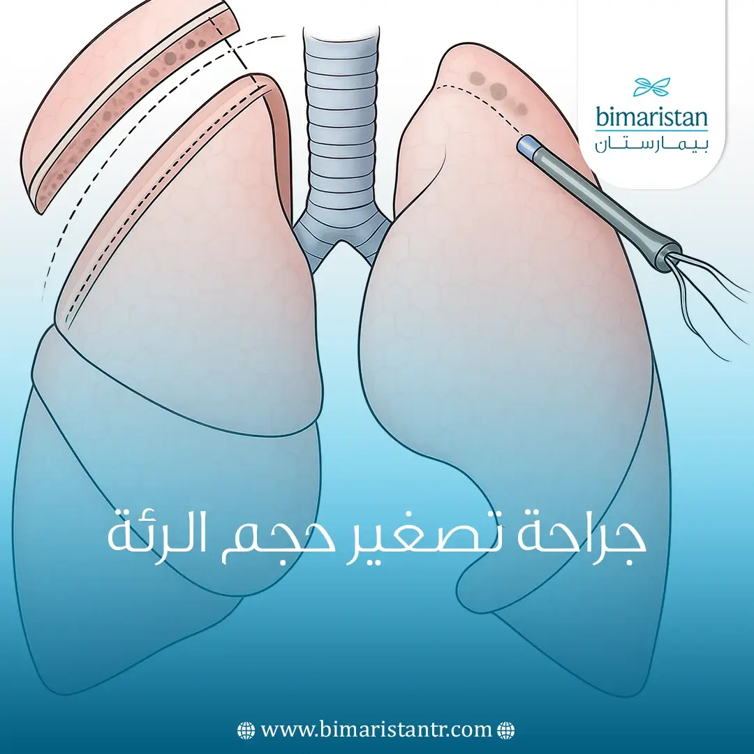 جراحة تصغير حجم الرئة