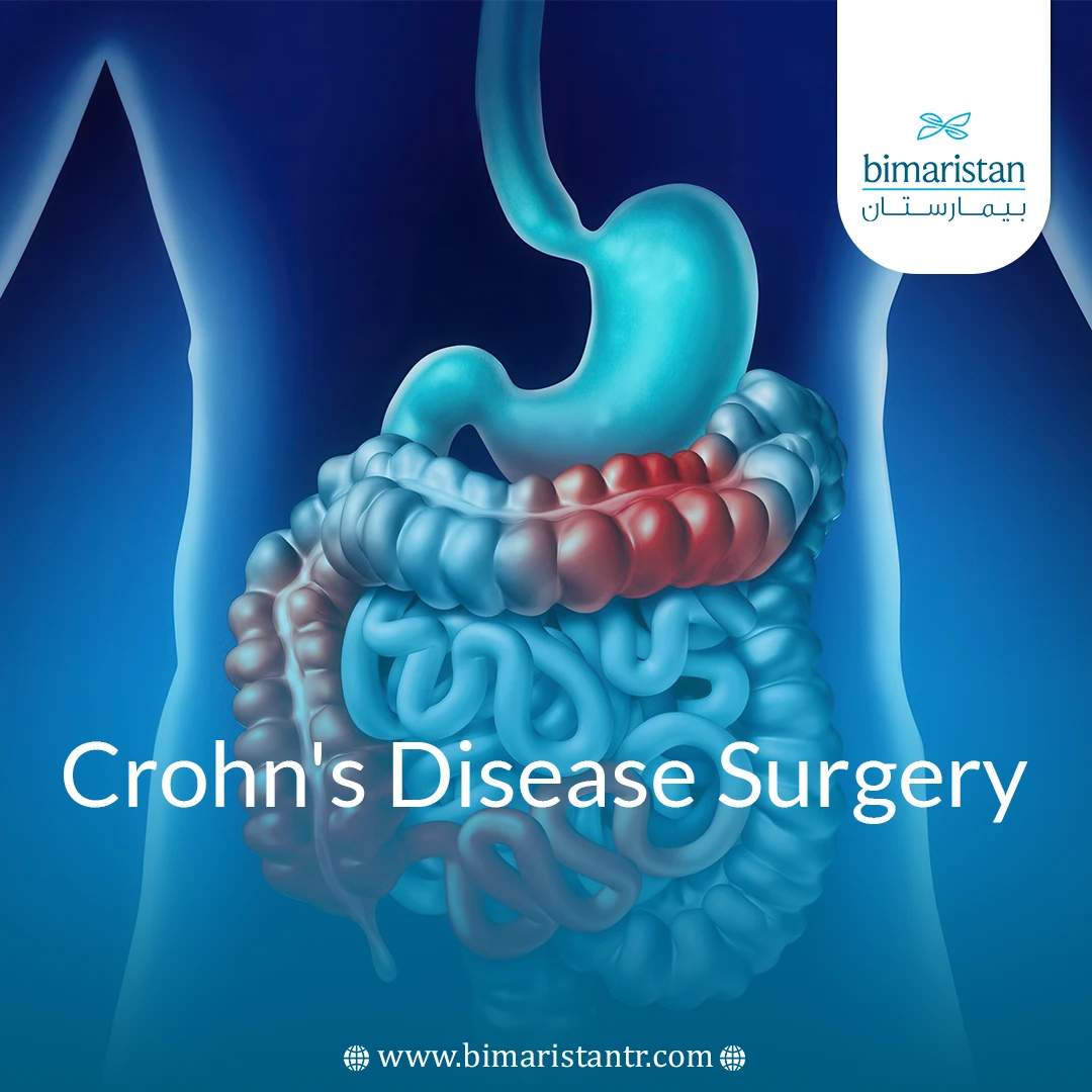 Crohn'S Disease Surgery