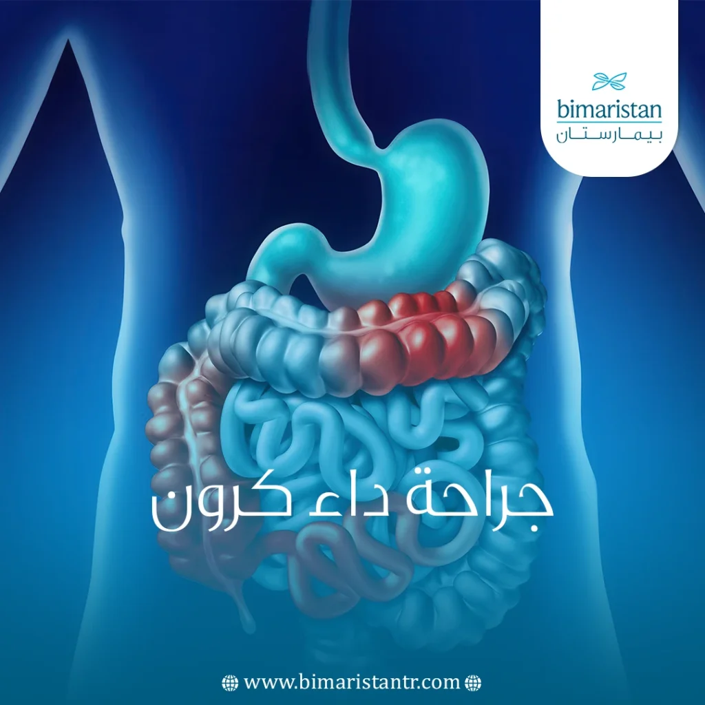 جراحة داء كرون