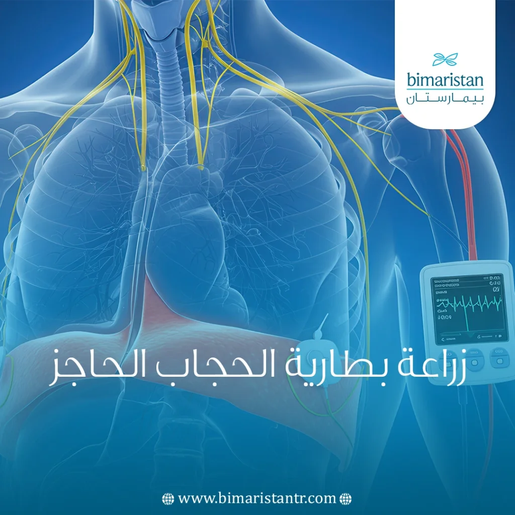 زراعة بطارية الحجاب الحاجز