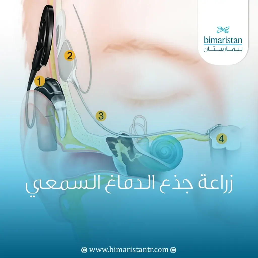 زراعة جذع الدماغ السمعي أفضل علاج للصم في تركيا