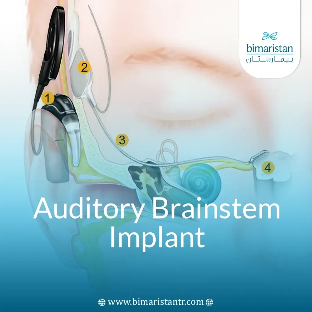 Auditory Brainstem Implant: Top Treatment For Deaf Patients