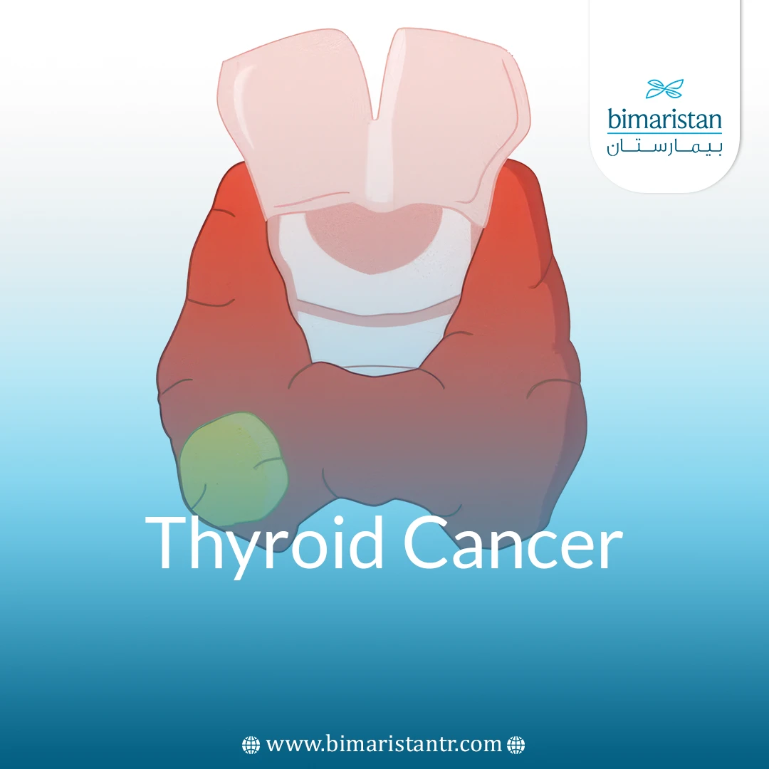 Thyroid Cancer: Signs, Symptoms &Amp;Amp; Effective Treatments Guide