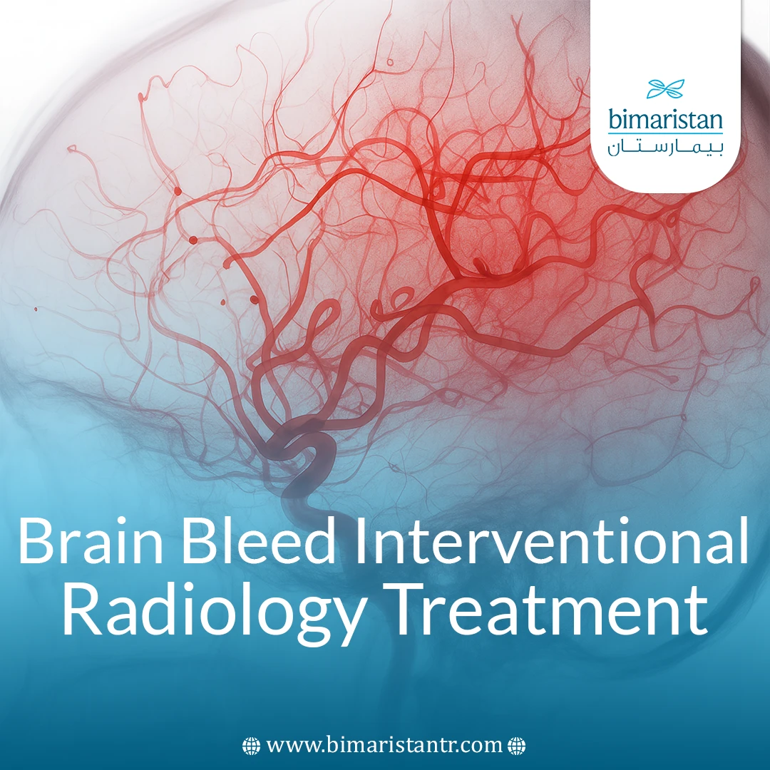 Brain Bleed Interventional Radiology Treatment: Life-Saver