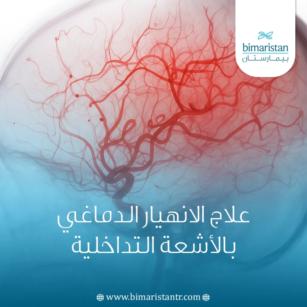 علاج الانهيار الدماغي بالأشعة التداخلية