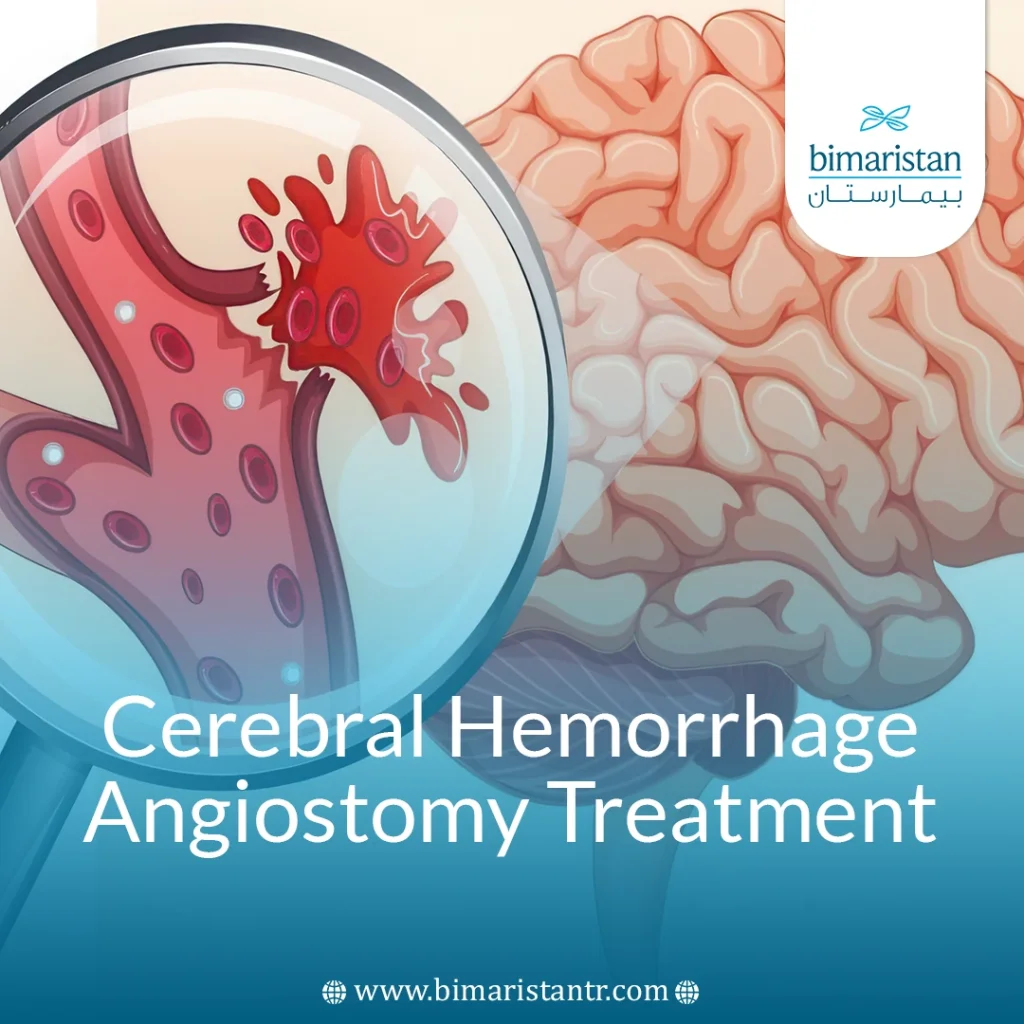 Cerebral Hemorrhage Angiostomy Treatment