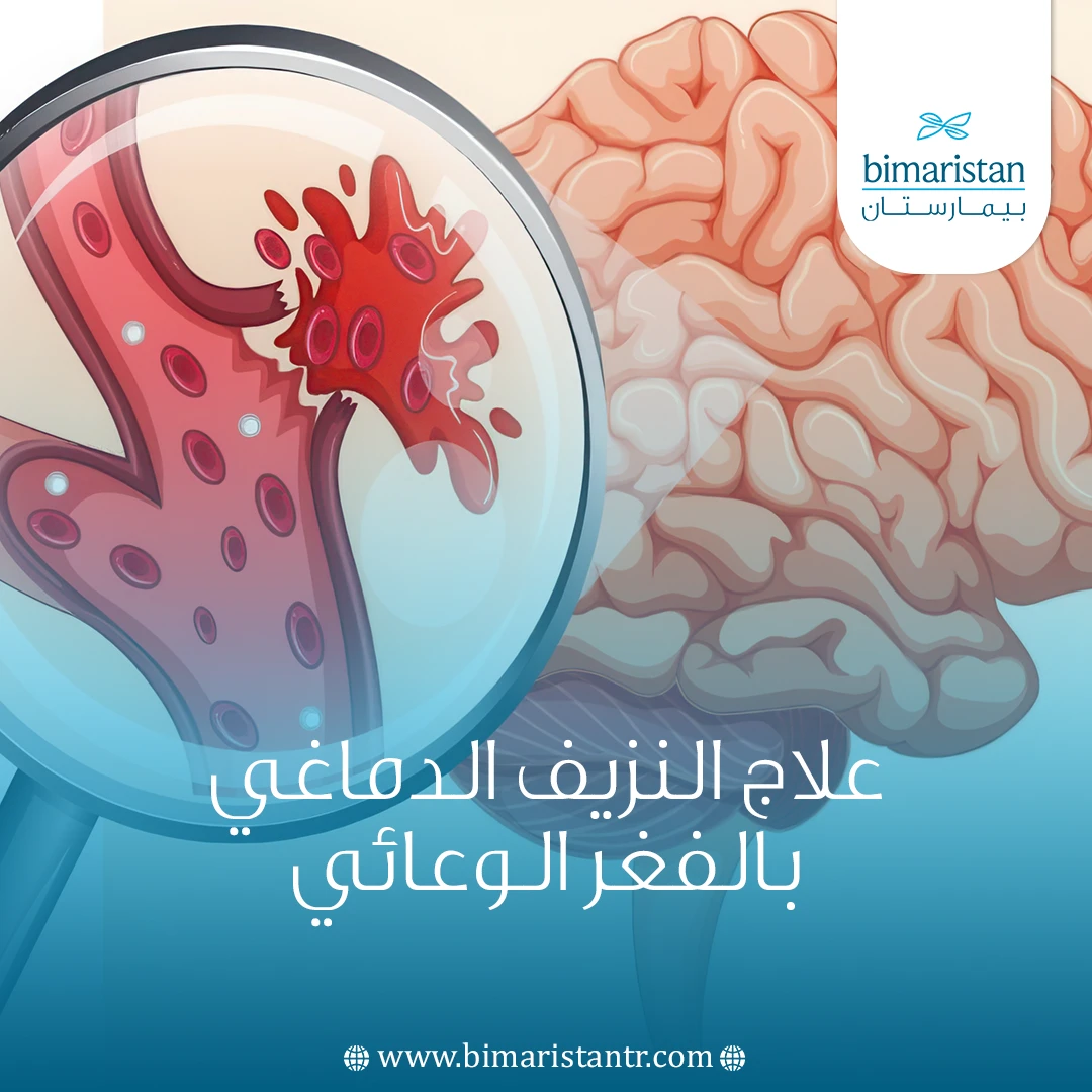 علاج النزيف الدماغي بالفغر الوعائي