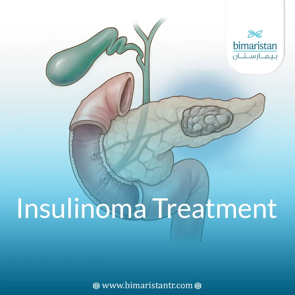 Insulinoma Treatment: Modern Methods &Amp; Low Sugar Control