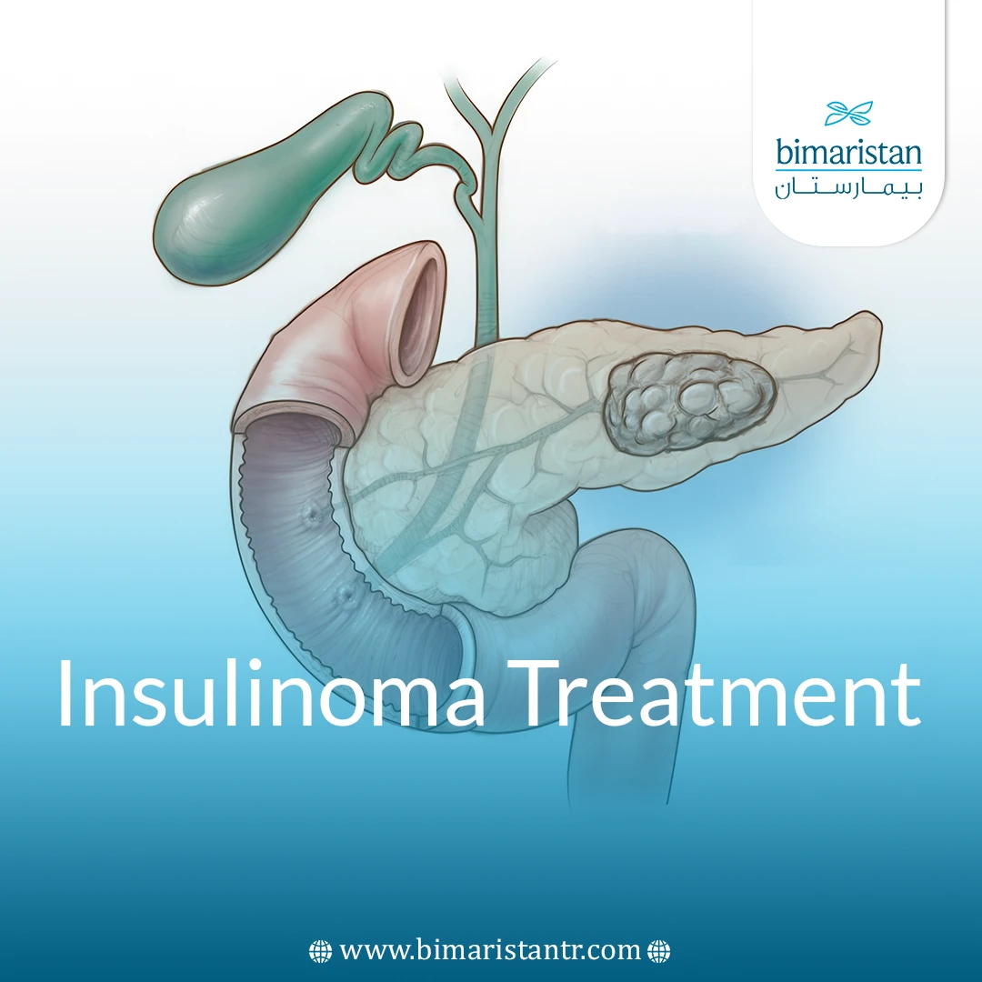 Insulinoma Treatment: Modern Methods &Amp;Amp; Low Sugar Control