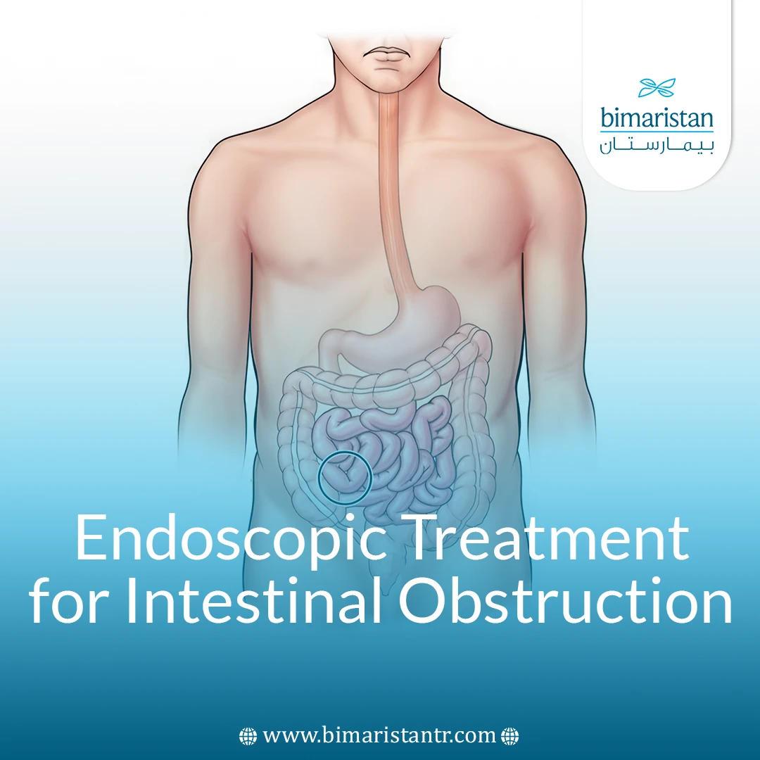 Endoscopic Treatment For Intestinal Obstruction: An Effective Alternative To Traditional Surgery