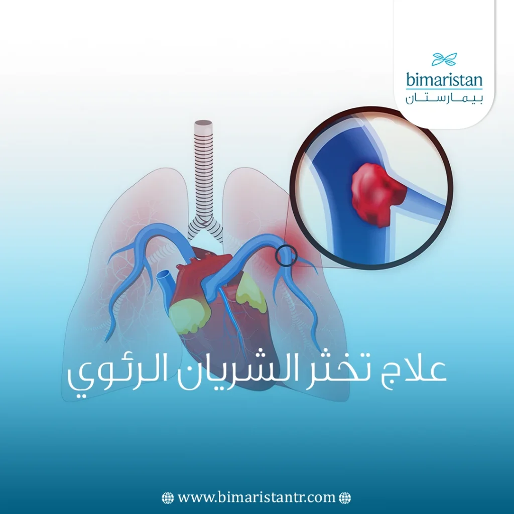 علاج تخثر الشريان الرئوي