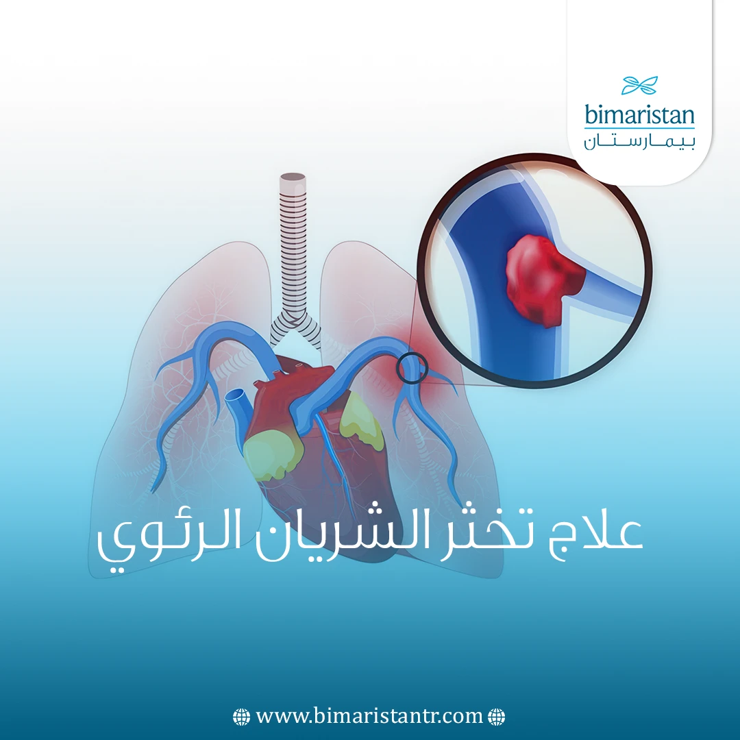 علاج تخثر الشريان الرئوي