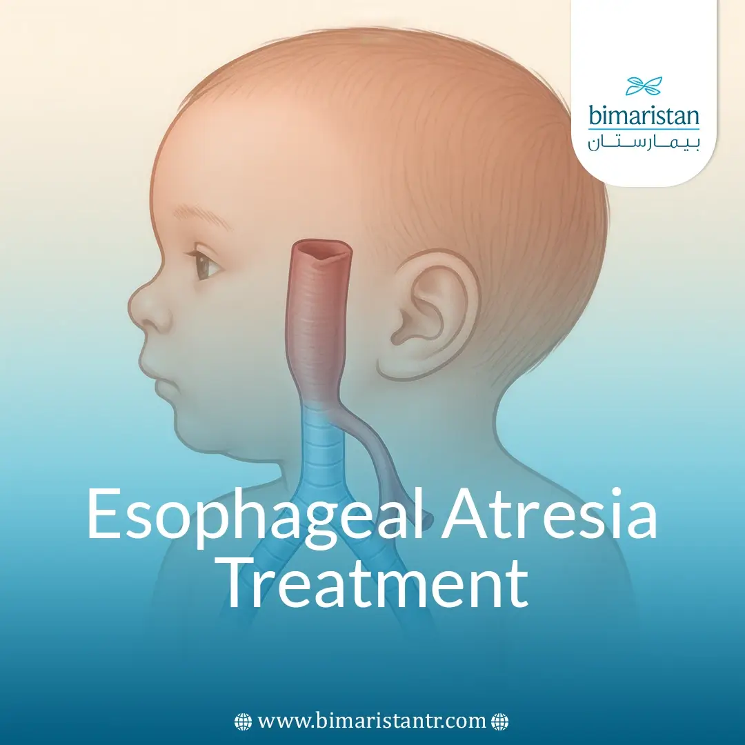 Esophageal Atresia Treatment &Amp;Amp; Tracheoesophageal Fistula Repair Guide