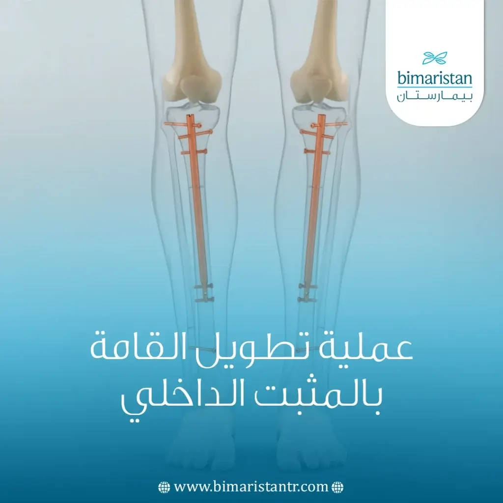 عملية تطويل القامة بالمثبت الداخلي