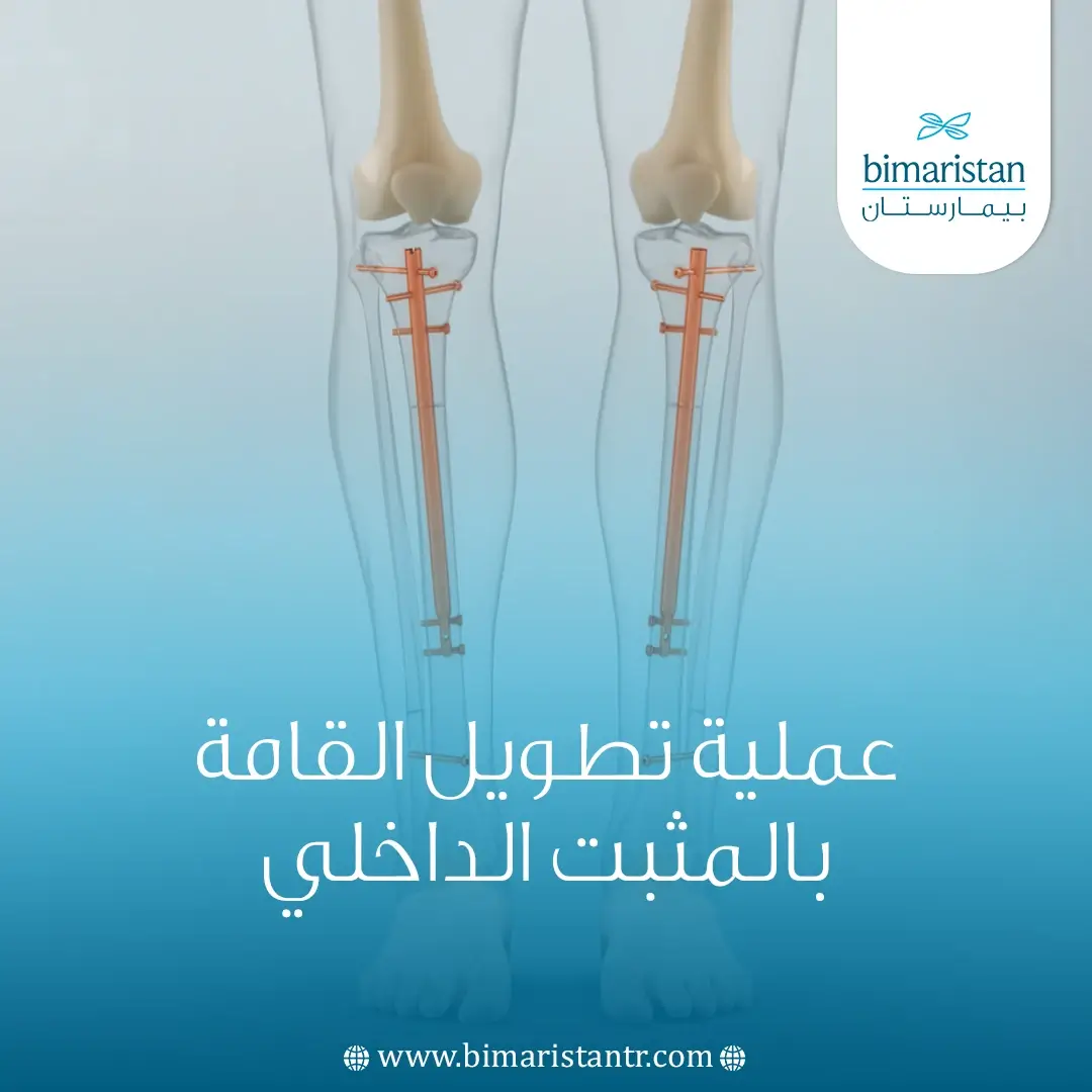 عملية تطويل القامة بالمثبت الداخلي