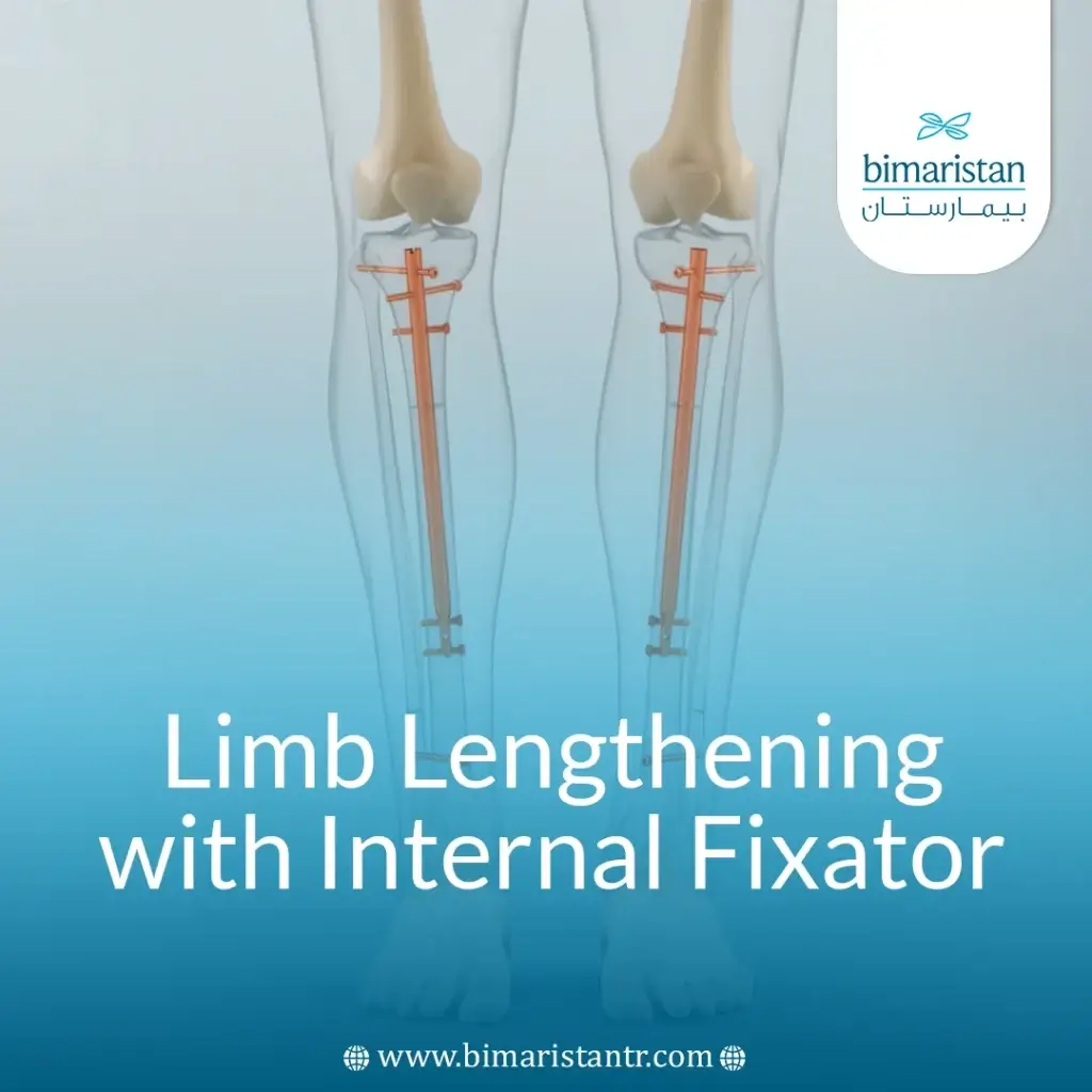 Height Lengthening Procedure With Internal Fixator: Guide