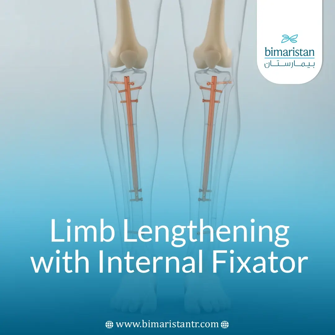 Height Lengthening Procedure With Internal Fixator: Guide