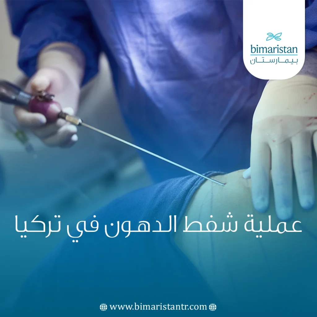 عملية شفط الدهون في تركيا