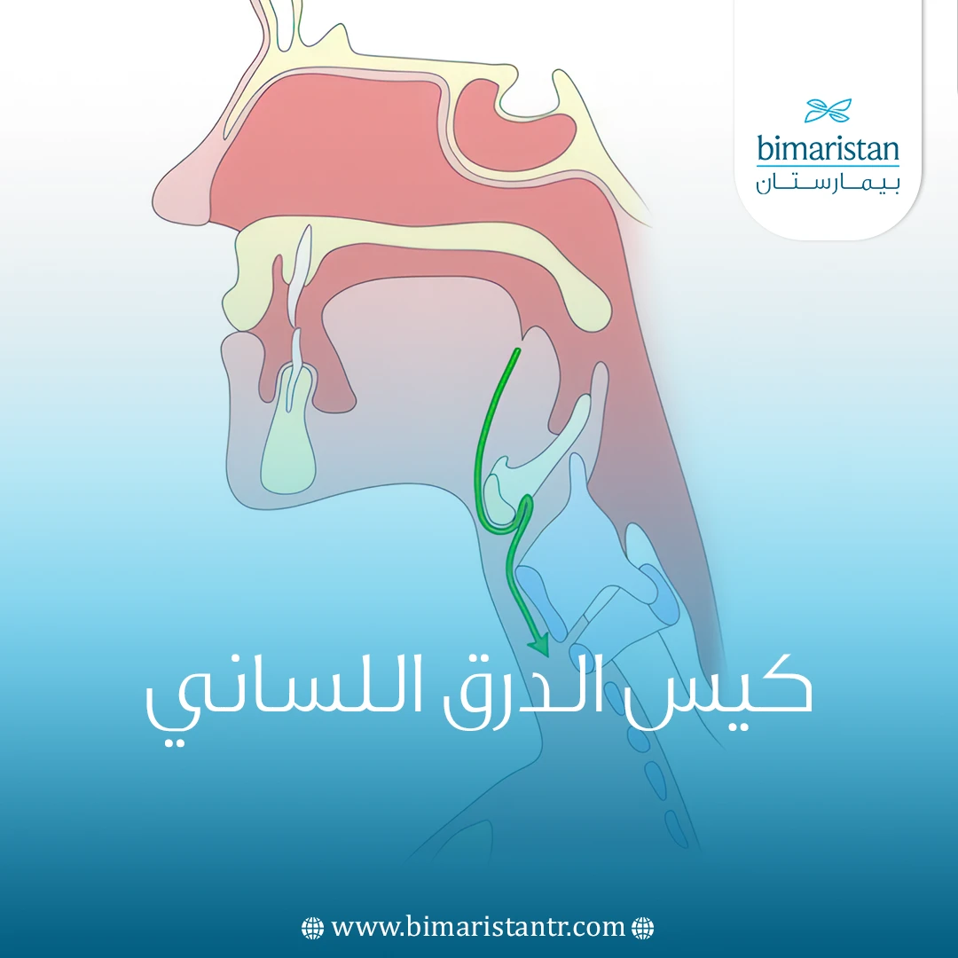 كيس الدرق اللساني