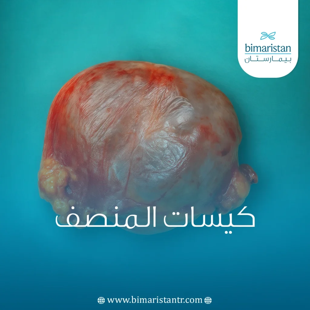كيسات المنصف