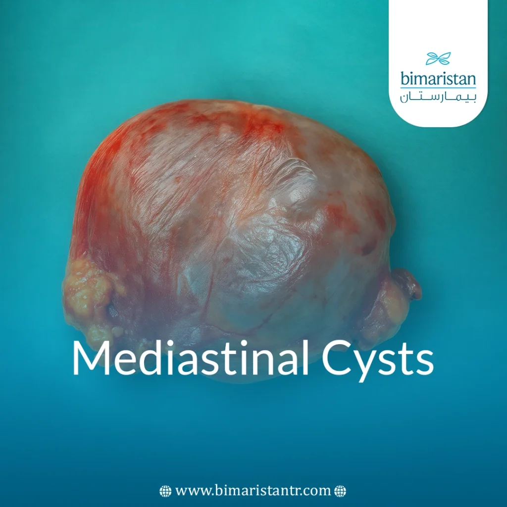 Mediastinal Cysts: Types, Causes, And Treatment Options