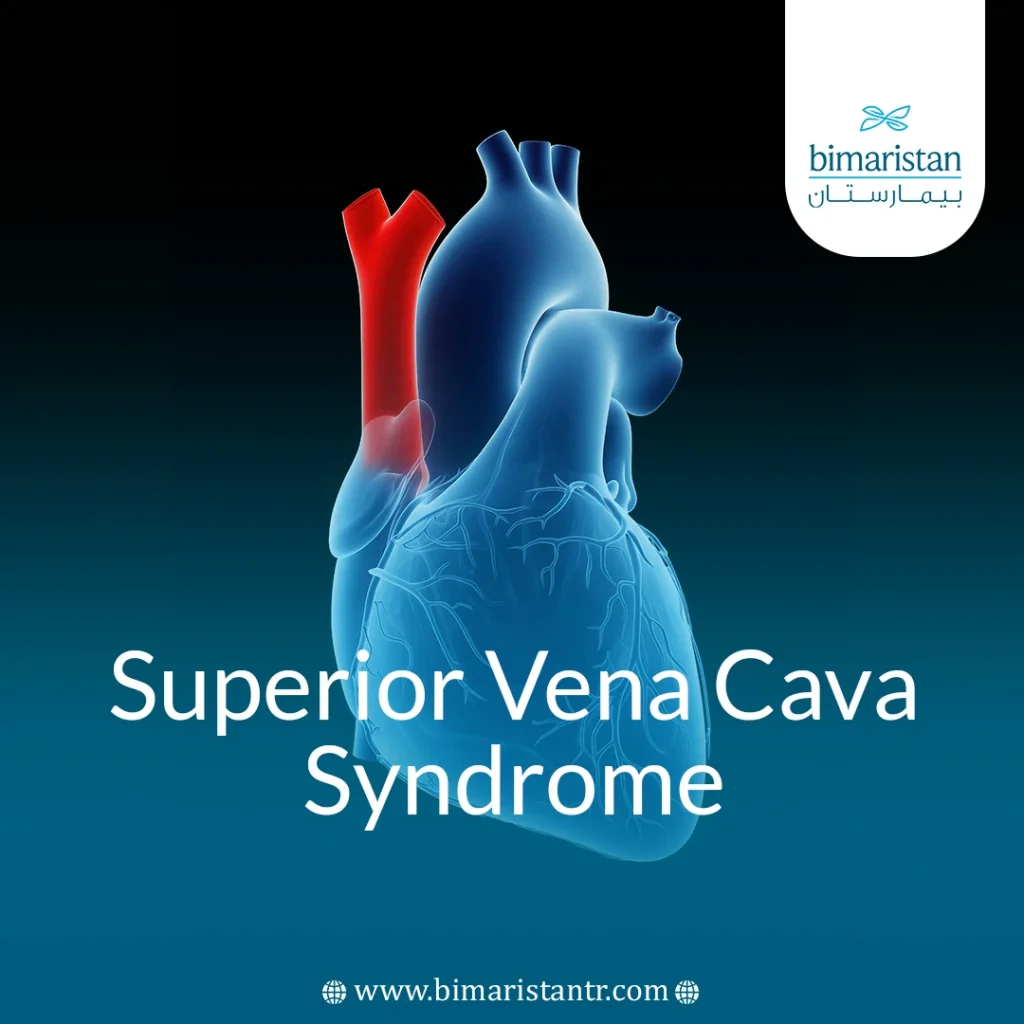 Superior Vena Cava Syndrome: Causes, Symptoms, Treatment