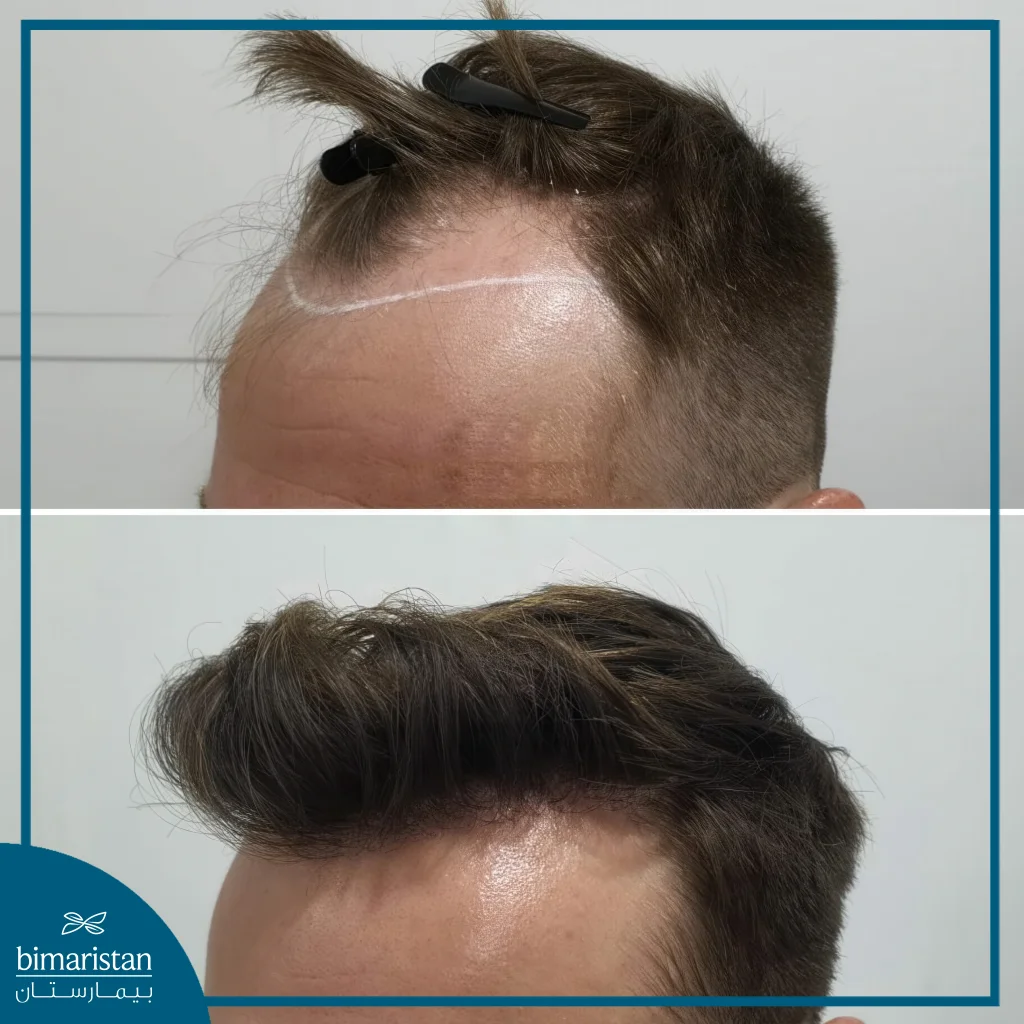 أفضل تقنية زراعة الشعر في تركيا: Dhi أم Fue؟ مقارنة شاملة قبل اتخاذ القرار 2 أفضل تقنية زراعة الشعر في تركيا: قبل وبعد