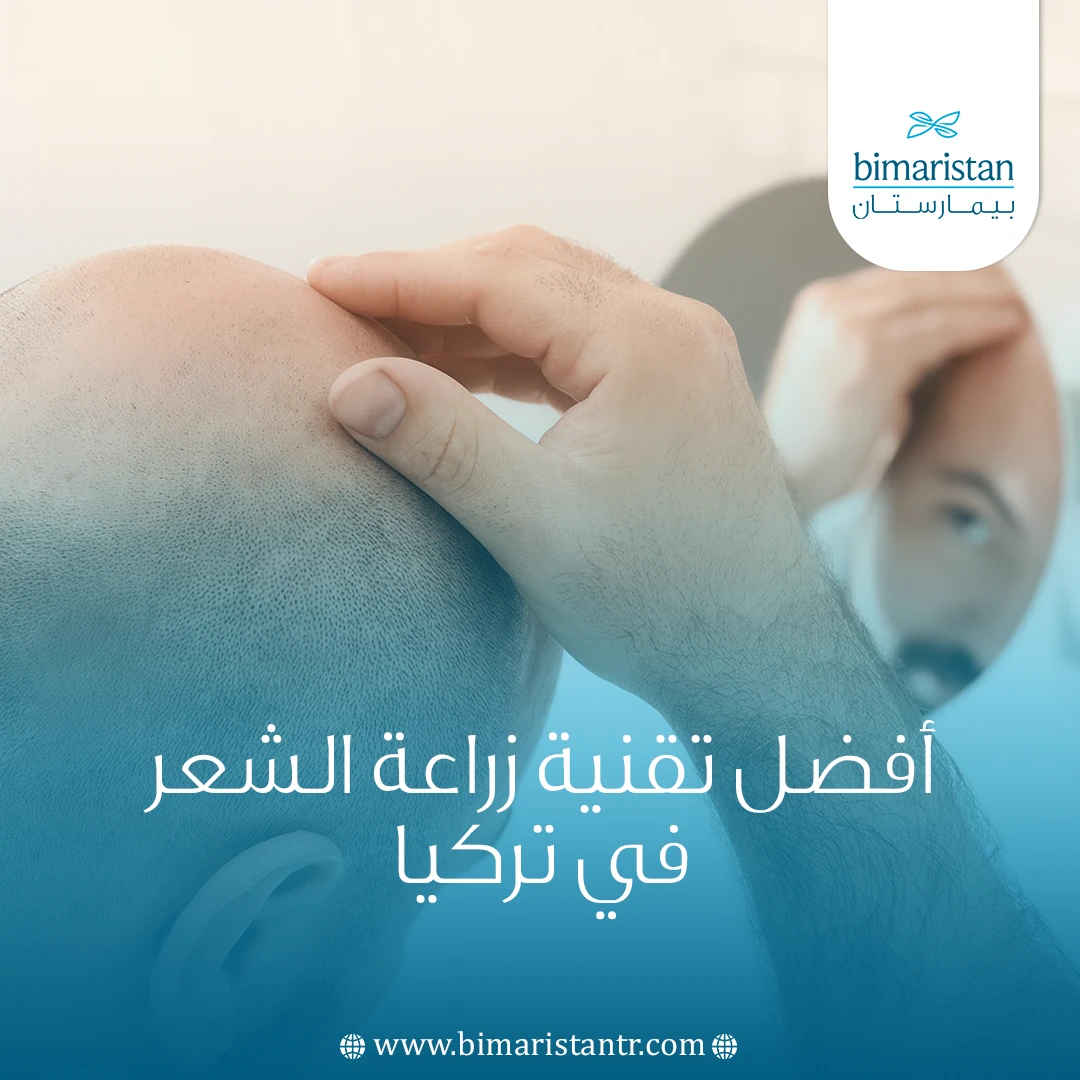 أفضل تقنية زراعة الشعر في تركيا