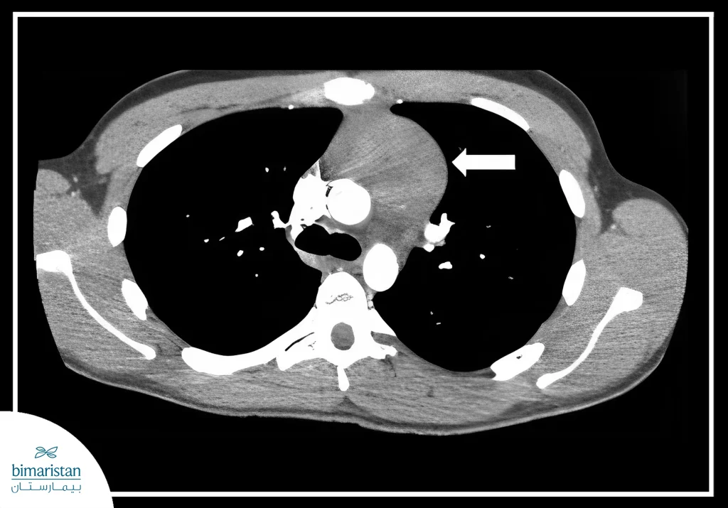Chest Ct With Mediastinal Diseases Mass.
