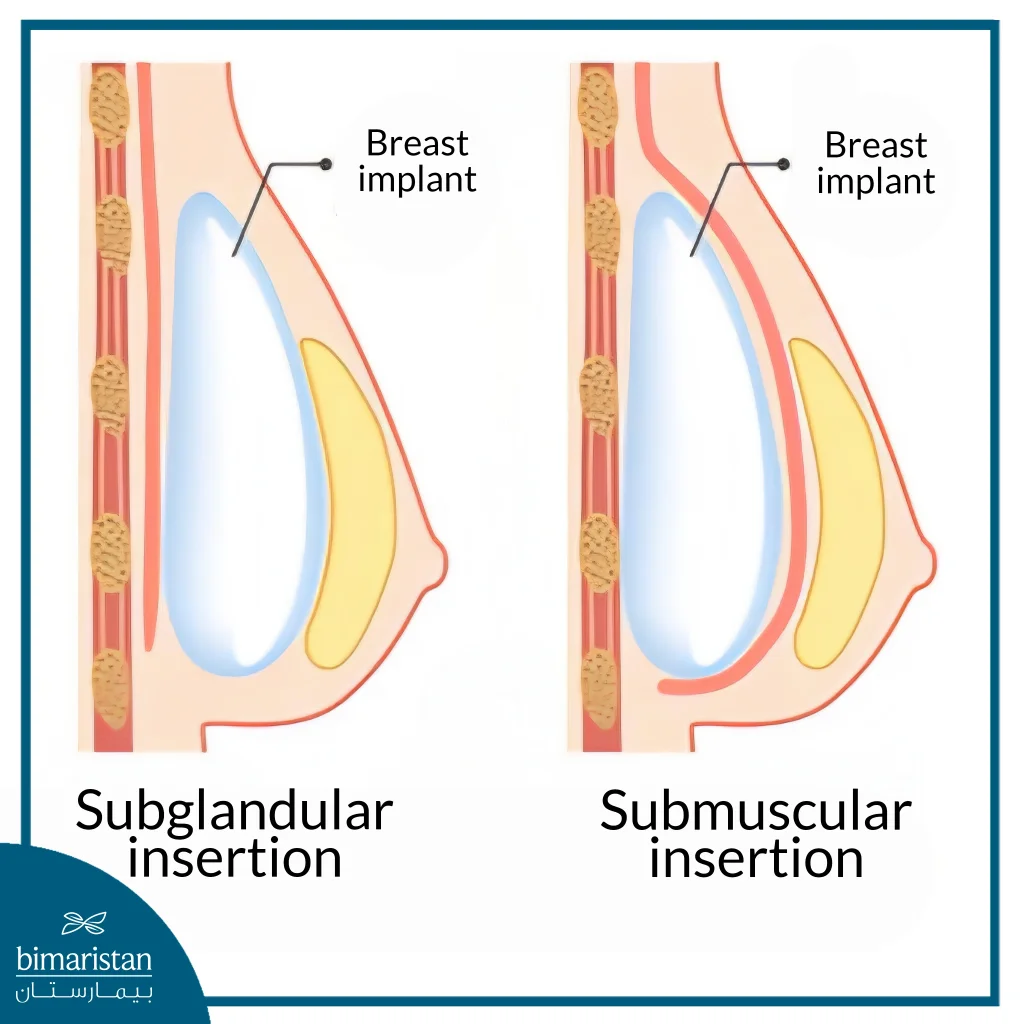 Breast Reconstruction After Mastectomy: Silicone Implants