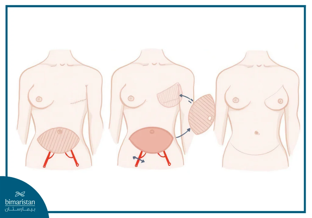 Breast Reconstruction After Mastectomy: Muscle Grafts
