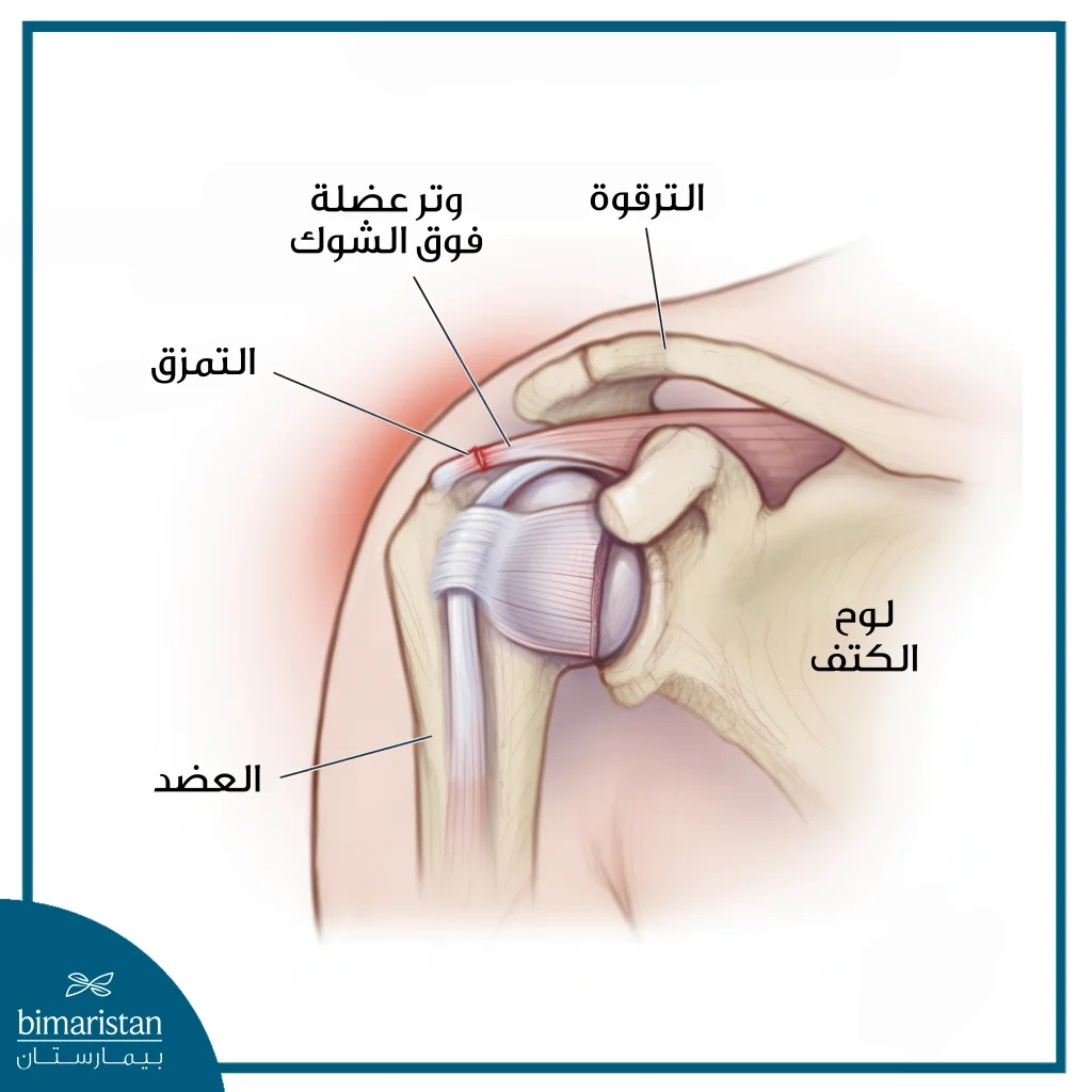 إعادة بناء الكتف بعد التمزق: عودة الحياة للكتف 10 إعادة بناء الكتف بعد التمزق: الكتف المتمزق