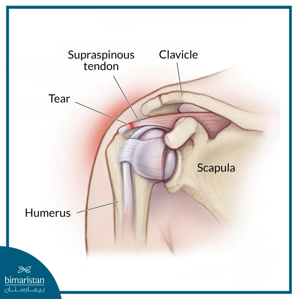 Rotator Cuff Repair After Rupture: Restore Shoulder Function 4 Rotator Cuff Repair After A Tear: Ruptured Shoulder